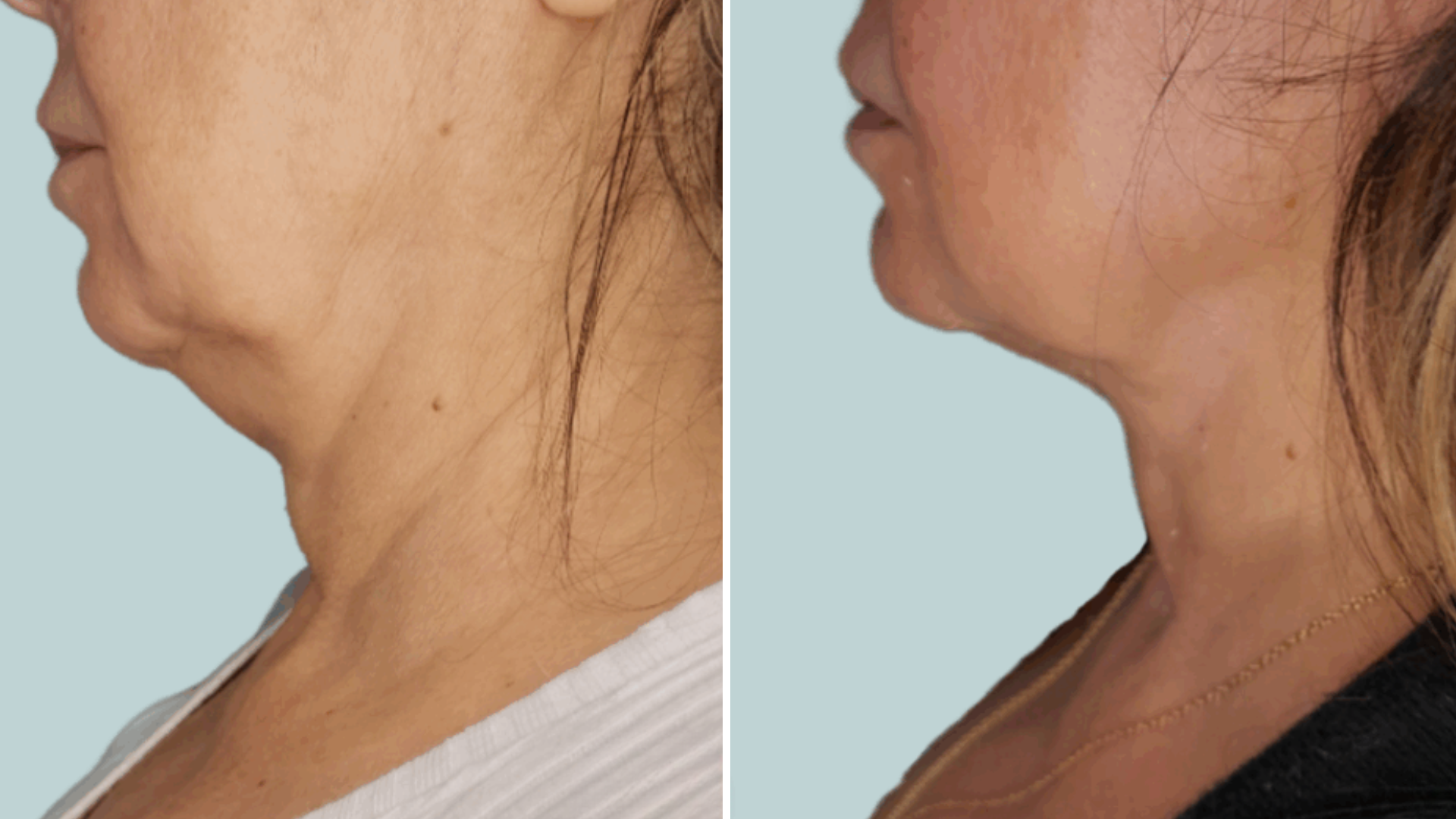 neck throat firmness